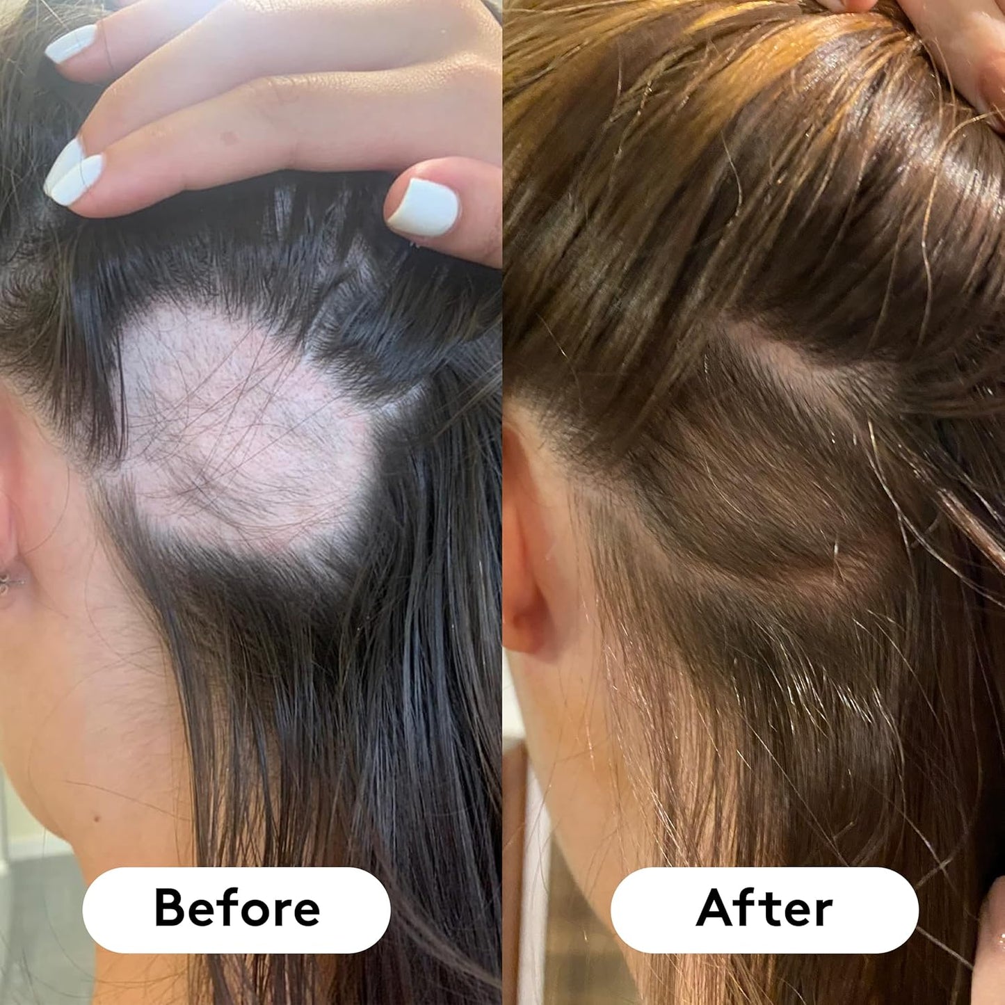 HAIR BURST Biotin Gummies for Hair Growth — Hair, Skin & Nails Vitamin Supplement, Reduces Breakage, Promotes Healthier Thicker- Daily Chewable Vitamins - 1 Month