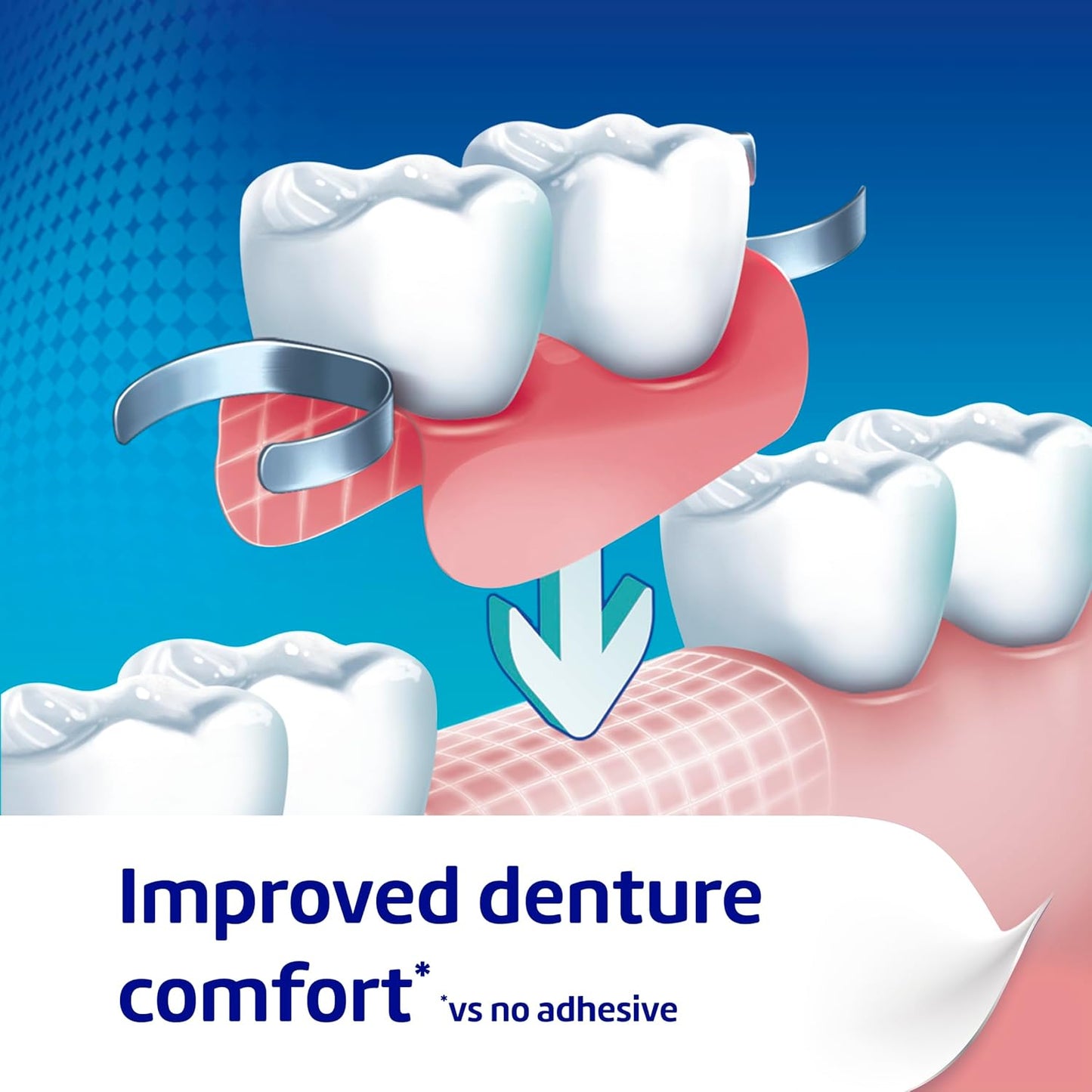 Poligrip Denture Adhesive Cream, False Teeth and Partials Fixative, Ultra, 40 g (Packaging may vary)